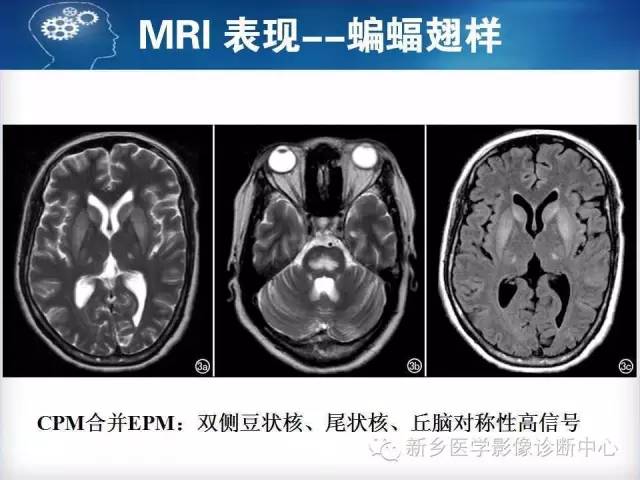 【病例】脑桥中央髓鞘溶解症1例MR影像表现
