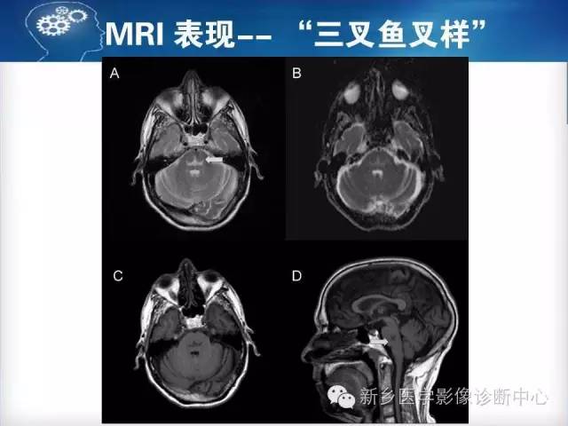 【病例】脑桥中央髓鞘溶解症1例MR影像表现
