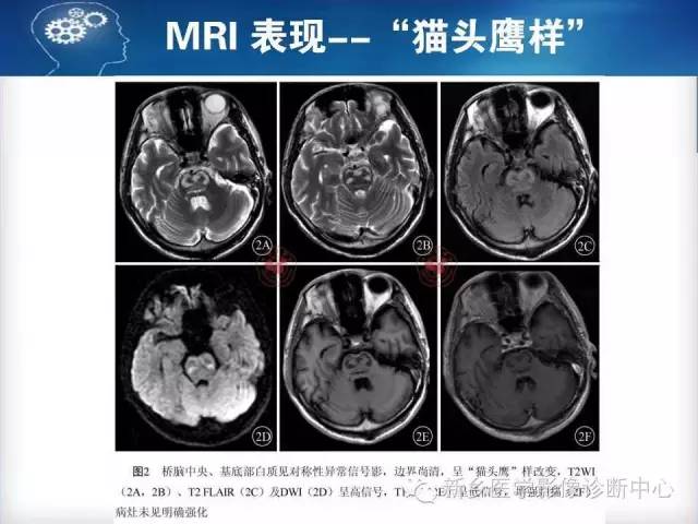【病例】脑桥中央髓鞘溶解症1例MR影像表现
