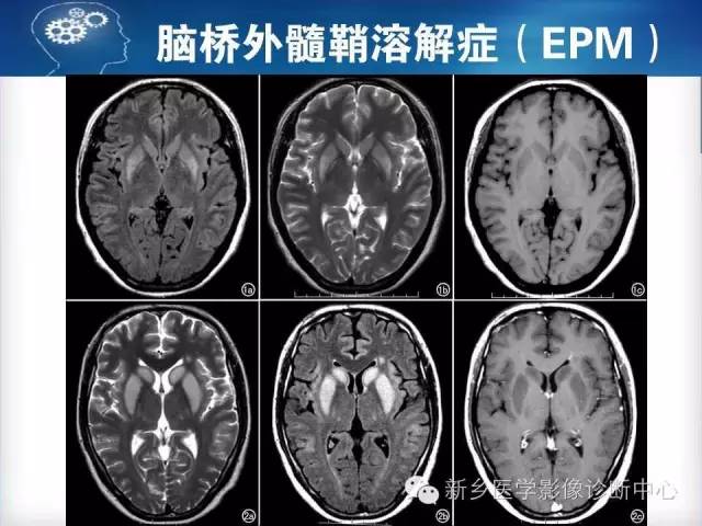 【病例】脑桥中央髓鞘溶解症1例MR影像表现