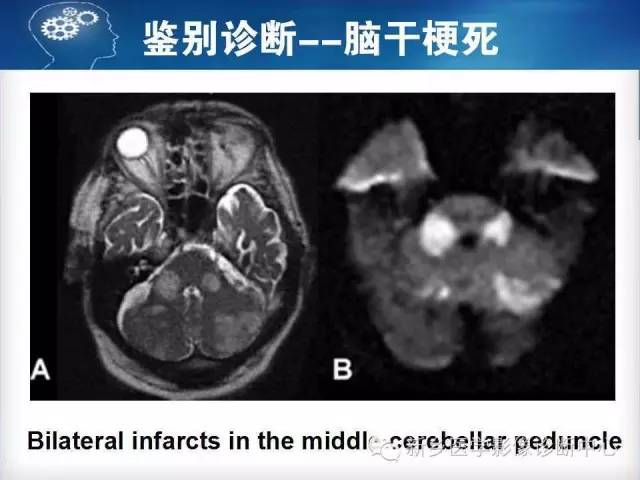 【病例】脑桥中央髓鞘溶解症1例MR影像表现