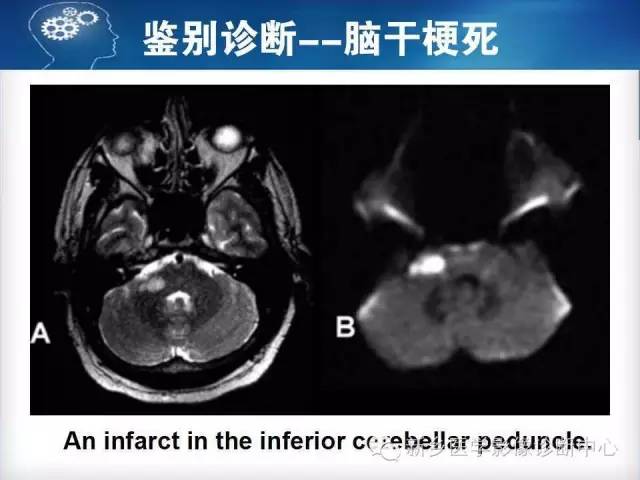 【病例】脑桥中央髓鞘溶解症1例MR影像表现