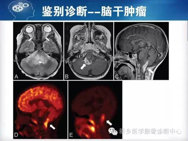 【病例】脑桥中央髓鞘溶解症1例MR影像表现