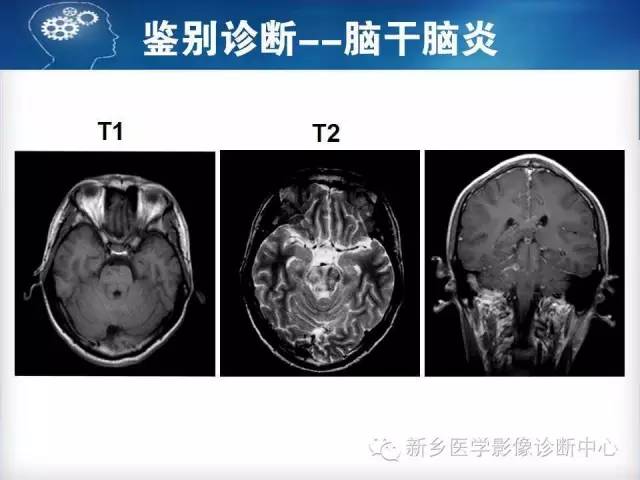 【病例】脑桥中央髓鞘溶解症1例MR影像表现