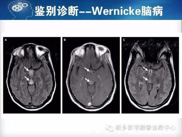 【病例】脑桥中央髓鞘溶解症1例MR影像表现