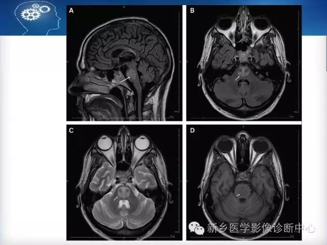 【病例】脑桥中央髓鞘溶解症1例MR影像表现
