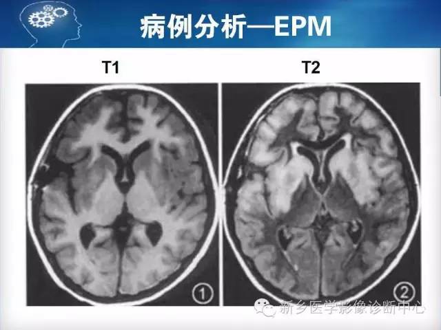 【病例】脑桥中央髓鞘溶解症1例MR影像表现