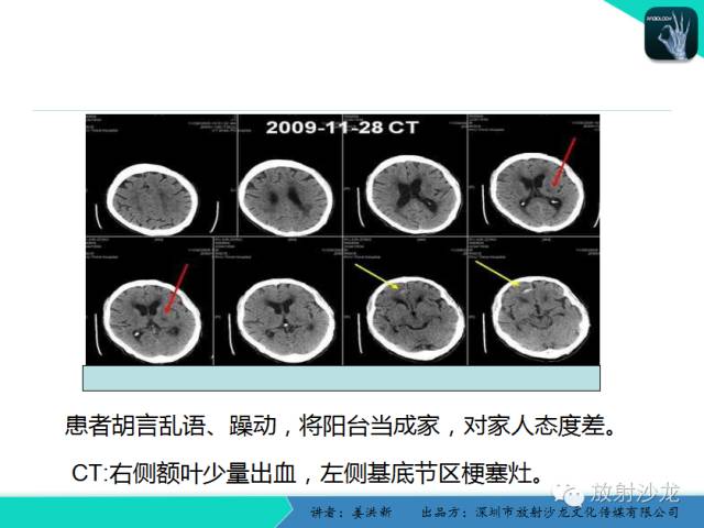 【PPT】脑小血管病MRI影像学研究