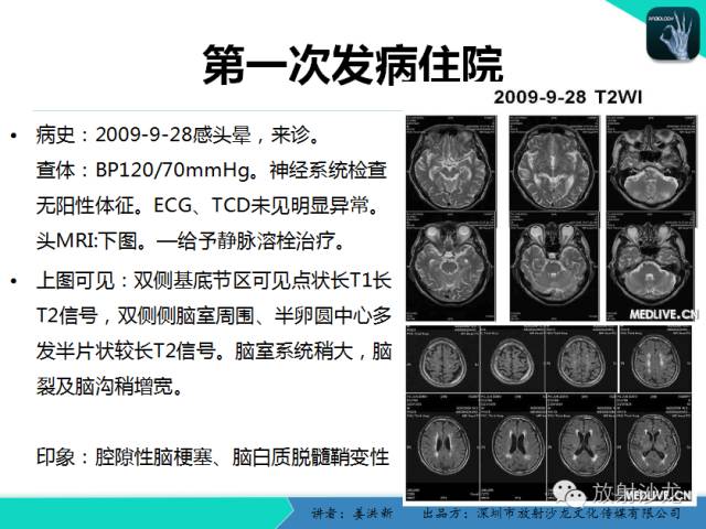 【PPT】脑小血管病MRI影像学研究