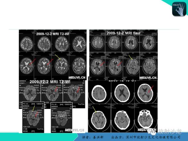 【PPT】脑小血管病MRI影像学研究