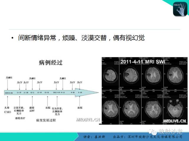 【PPT】脑小血管病MRI影像学研究