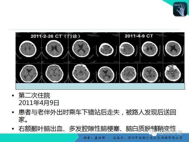 【PPT】脑小血管病MRI影像学研究