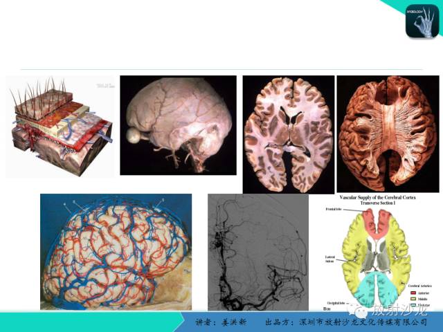 【PPT】脑小血管病MRI影像学研究