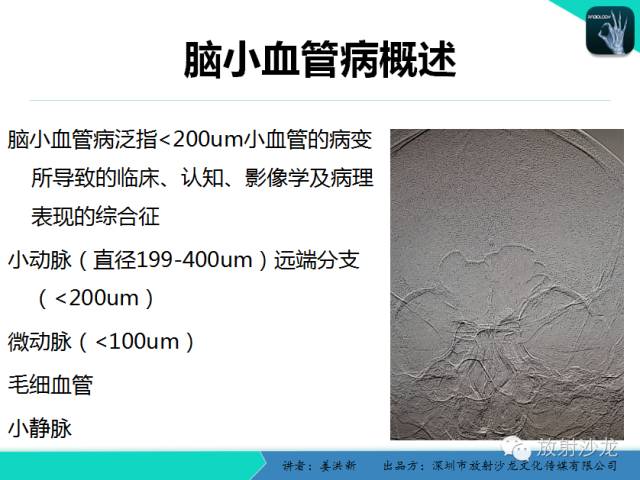 【PPT】脑小血管病MRI影像学研究