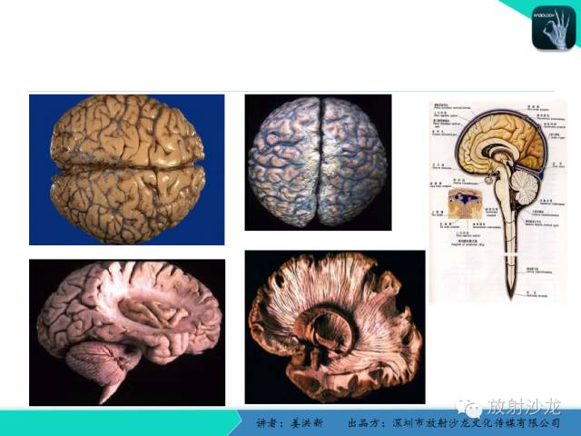 【PPT】脑小血管病MRI影像学研究