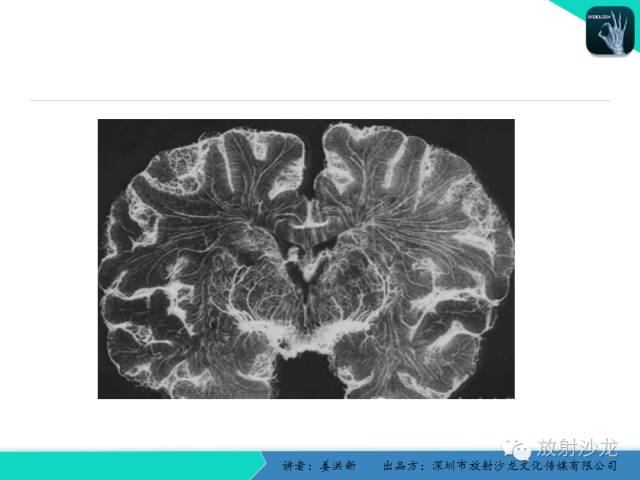 【PPT】脑小血管病MRI影像学研究
