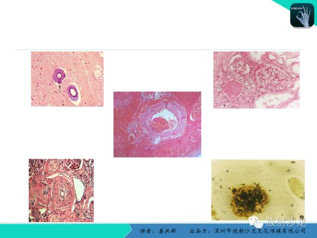 【PPT】脑小血管病MRI影像学研究