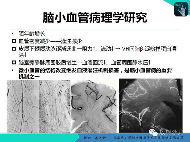 【PPT】脑小血管病MRI影像学研究