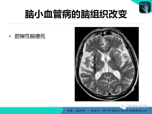 【PPT】脑小血管病MRI影像学研究