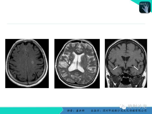 【PPT】脑小血管病MRI影像学研究