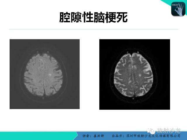 【PPT】脑小血管病MRI影像学研究