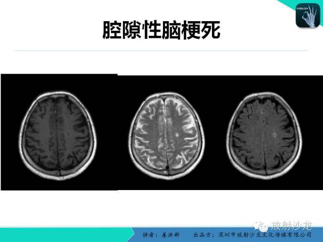 【PPT】脑小血管病MRI影像学研究