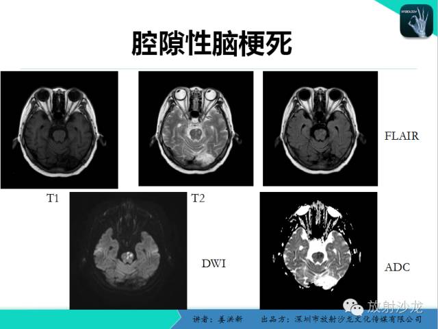【PPT】脑小血管病MRI影像学研究
