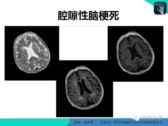 【PPT】脑小血管病MRI影像学研究