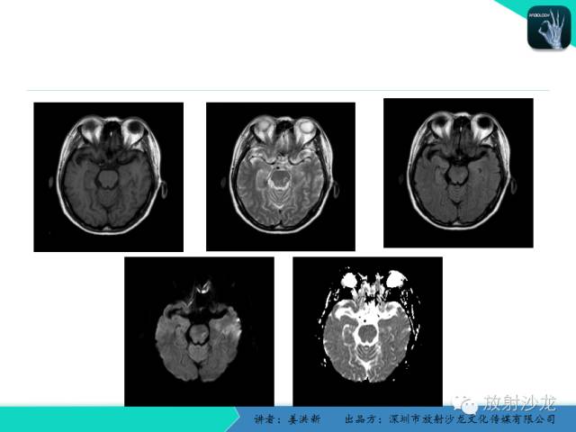 【PPT】脑小血管病MRI影像学研究
