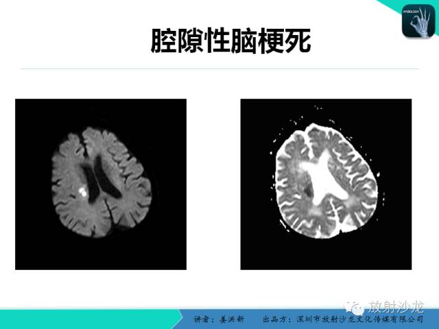 【PPT】脑小血管病MRI影像学研究