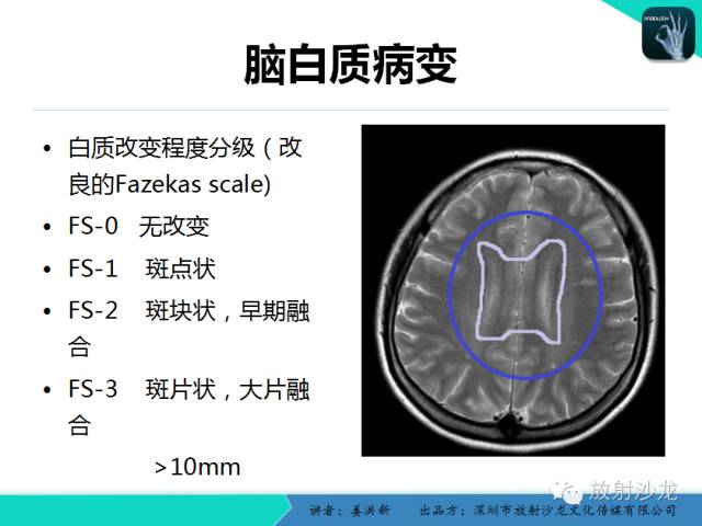 【PPT】脑小血管病MRI影像学研究