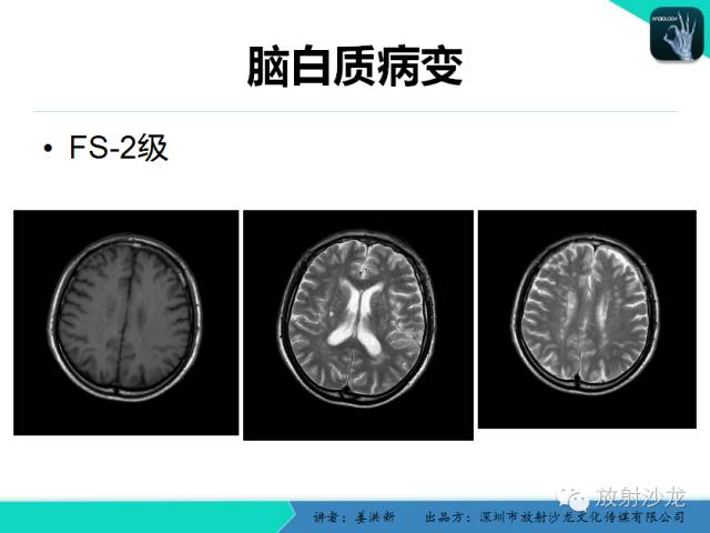 【PPT】脑小血管病MRI影像学研究