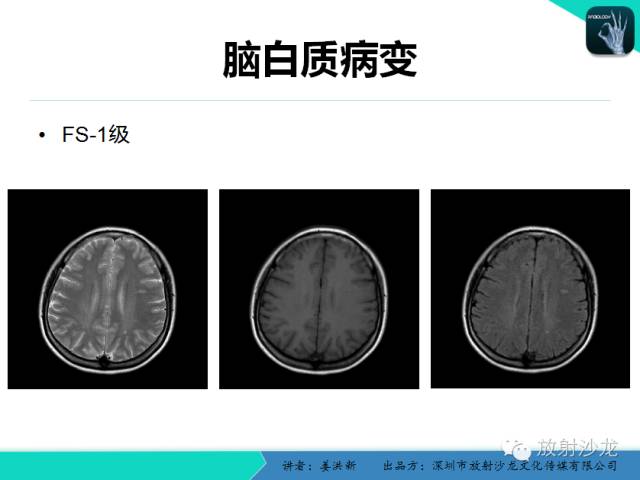 【PPT】脑小血管病MRI影像学研究