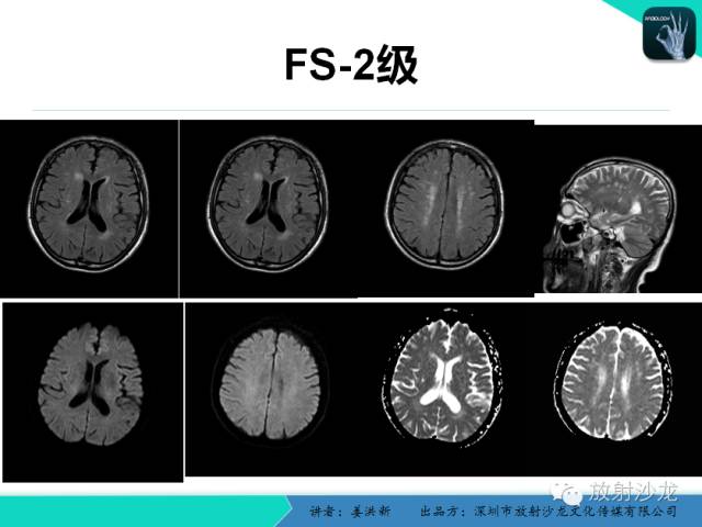 【PPT】脑小血管病MRI影像学研究