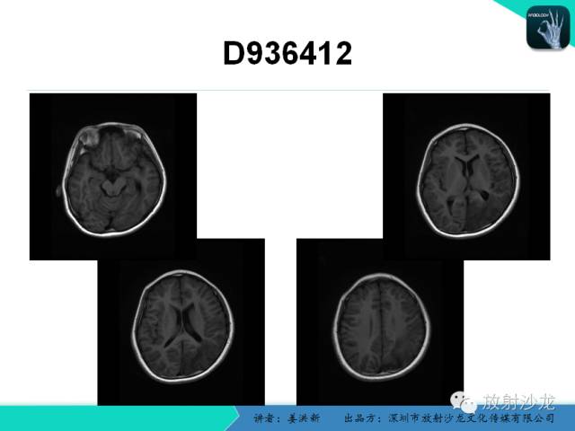【PPT】脑小血管病MRI影像学研究
