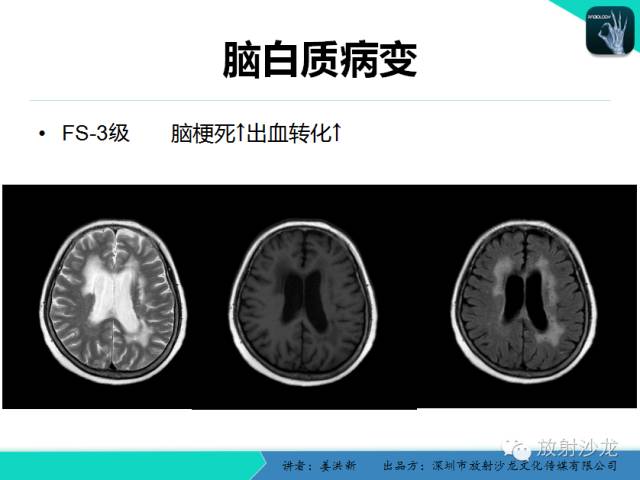 【PPT】脑小血管病MRI影像学研究