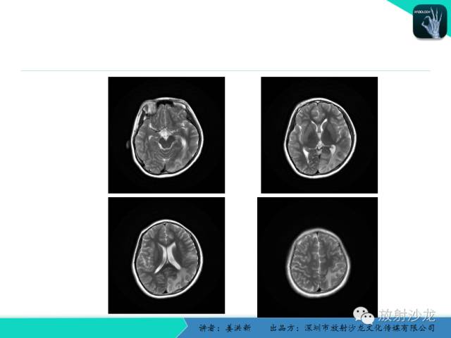 【PPT】脑小血管病MRI影像学研究