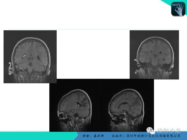 【PPT】脑小血管病MRI影像学研究