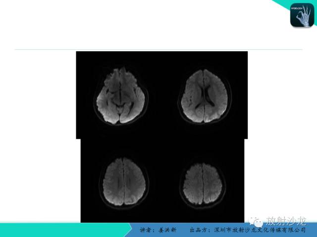 【PPT】脑小血管病MRI影像学研究