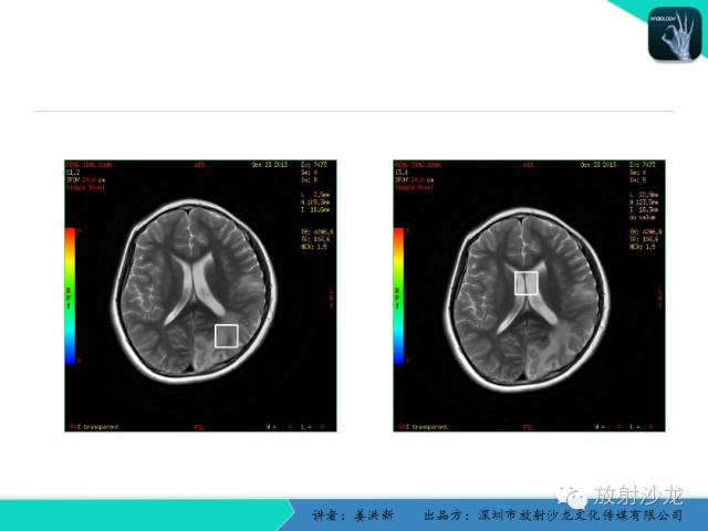 【PPT】脑小血管病MRI影像学研究