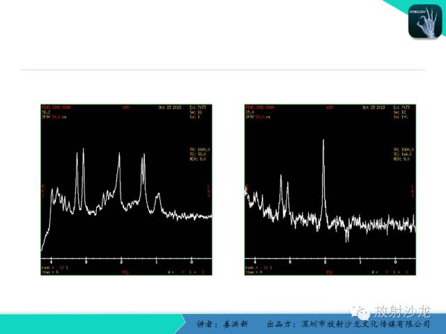 【PPT】脑小血管病MRI影像学研究