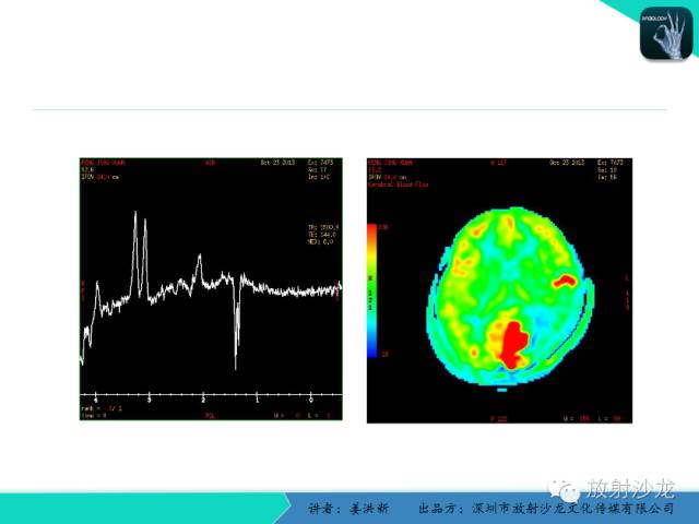 【PPT】脑小血管病MRI影像学研究