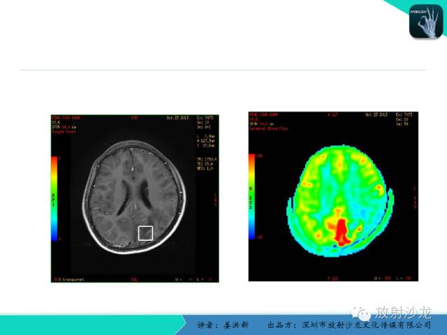 【PPT】脑小血管病MRI影像学研究