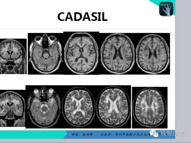 【PPT】脑小血管病MRI影像学研究