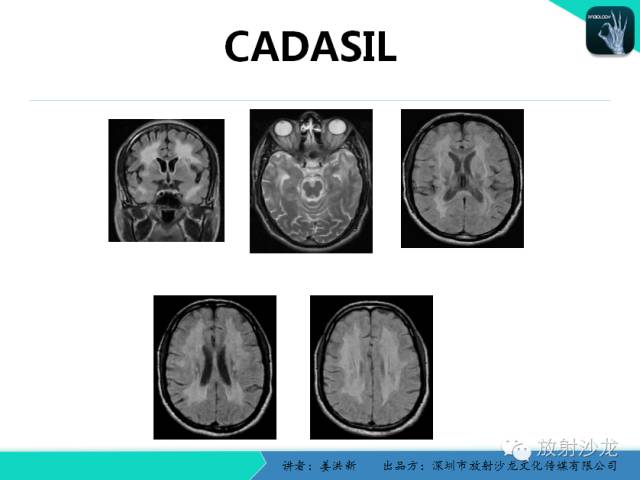 【PPT】脑小血管病MRI影像学研究