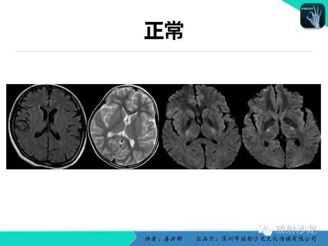 【PPT】脑小血管病MRI影像学研究