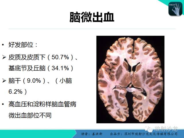 【PPT】脑小血管病MRI影像学研究