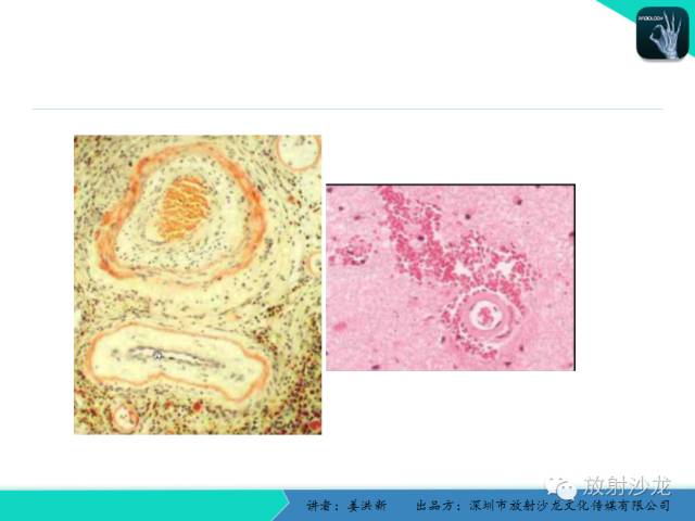 【PPT】脑小血管病MRI影像学研究