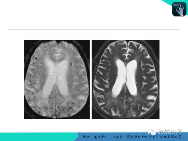 【PPT】脑小血管病MRI影像学研究
