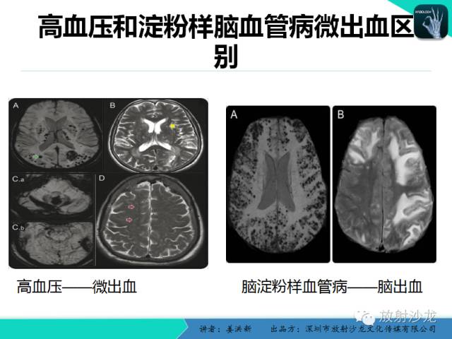 【PPT】脑小血管病MRI影像学研究